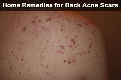 21 Diy Home Remedies For Back Acne Scars
