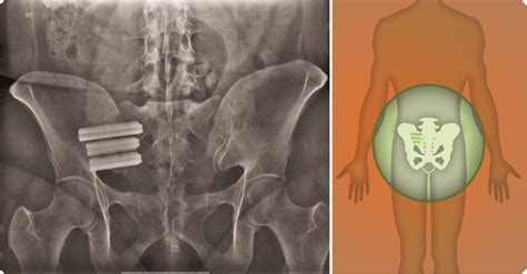 Sacroiliac Fusion