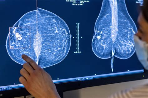 Ai Mammography Detects More Cancers Cuts Workload Study Ai Tools