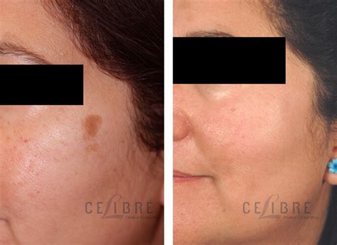 Sun Spots Removal Before And After Pictures 4