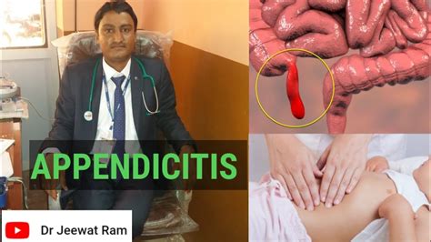 Appendicitis Signs Symptoms Causes Diagnosis And Treatment Youtube