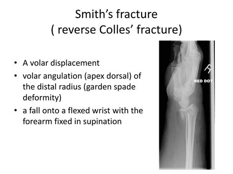 Ppt Common Adult Fractures Powerpoint Presentation Free Download