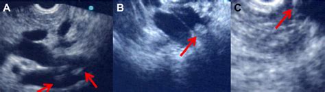 Common Bile Duct Stones Detected By Linear Endoscopic Ultrasound In A