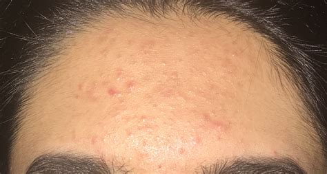 Forehead Acne Ive Given Up Hyperpigmentation Reddark Marks