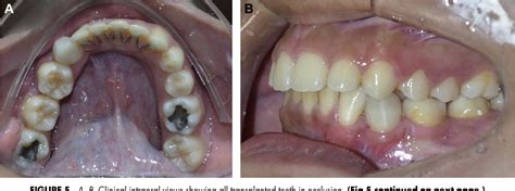 Figure 5 From Autotransplantation Of Immature Third Molars And