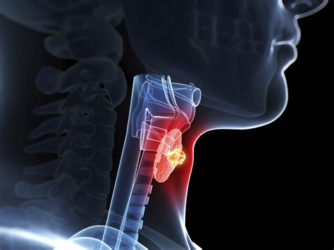 One Big Reason Aggressive Thyroid Cancer Is On The Rise