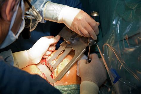 Heart Bypass Surgery Photograph By Antonia Reevescience Photo Library