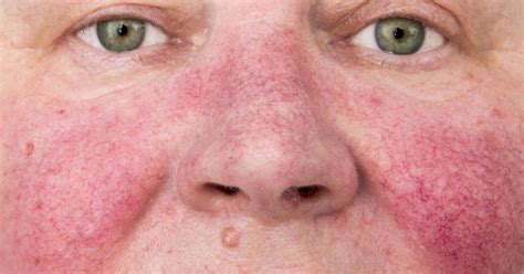 Lupus Rash The Top 10 Questions