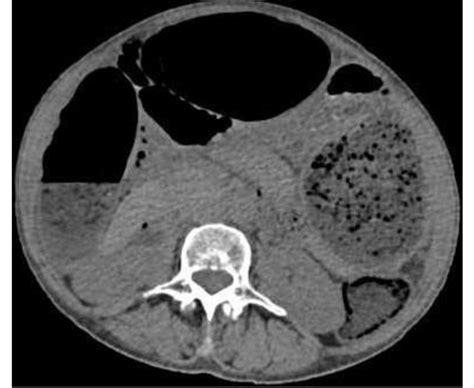 Abdomino Pelvic Ct Scan In Axial View Showing Distension Of The