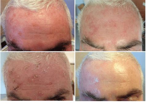 Ja Stammbaum Was Auch Immer Laser Treatment For Actinic Keratosis