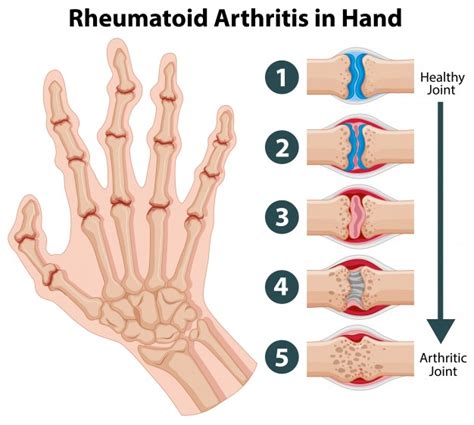 Free Vector Diagram Showing Rheumatoid Arthritis In A Hand