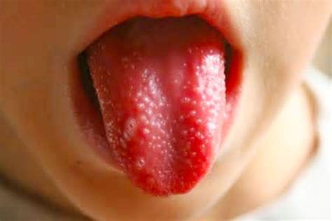 Lie Bumps Causes Symptoms Treatment And Prevention