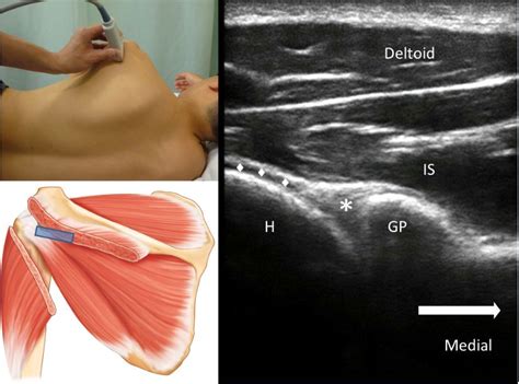 How I Do It Ultrasound Guided Injection For The Shoulder Part 2