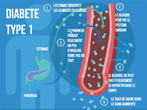 Treatment options include medications, a type 2 diabetes diet. Les différents types de diabète | Type 1 | Type 2 | MODY ...