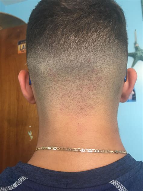 Rash On Back Of Neck After Haircut Best Haircut 2020