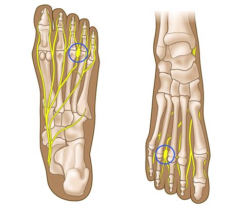 Mortons Neuroma Insole Clinic Leading Foot Solutions
