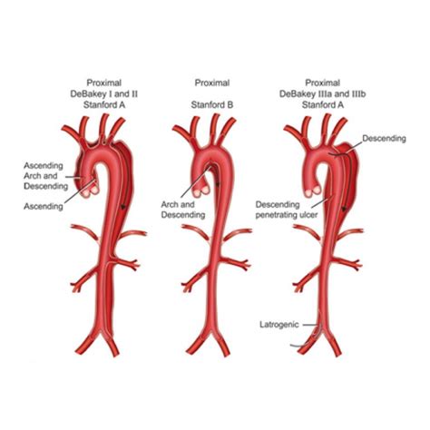 Aortic Dissection Surgeon Endovascular Surgery Bangalore Vascular