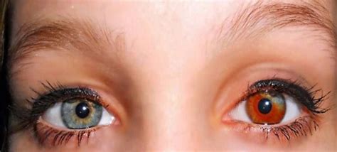 Pin By Maria Quinn On Heterochromia Iridis Heterochromia Different Colored Eyes