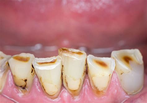 Worn Teeth The Avenue Dental
