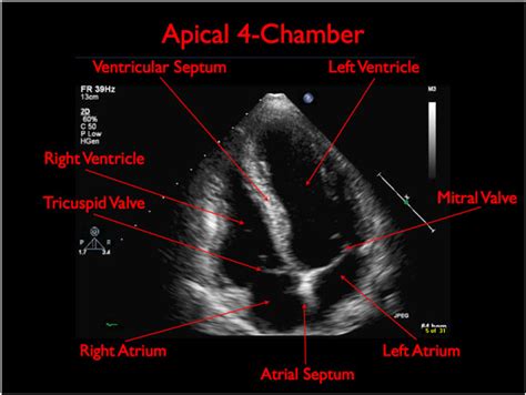 Apical Four Chamber View Toronto Notes