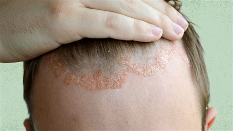 What Is Scalp Eczema Symptoms Causes Treatment And More