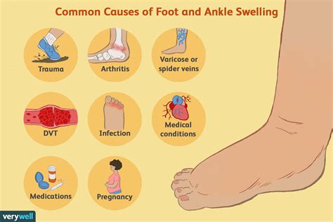 Common Causes Of Foot And Ankle Swelling Swollen Legs Foot And Ankle