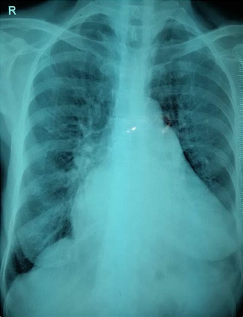 Cardiomegaly Chest Xray