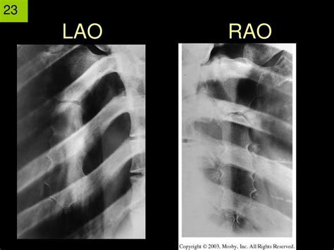 Ppt Shoulder Ch 6 And Bony Thorax Ch 9 Part 3 Scapula Sternum Ribs