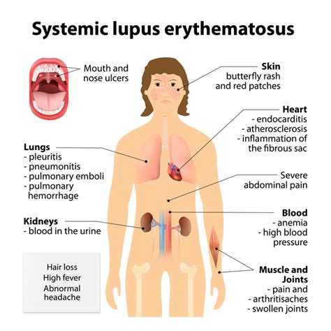 Systemic Lupus Erythematosus Symptoms Systemic Lupus Erythematosus The Best Porn Website