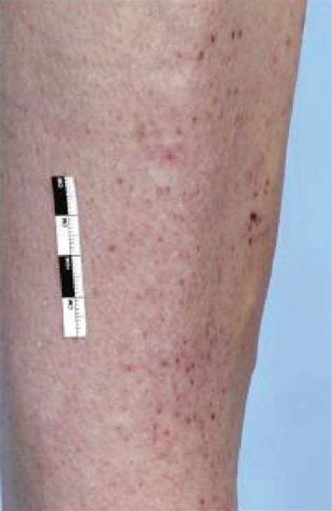 4 Pseudovasculitic Rash Occurring In A Patient With Privational Scurvy