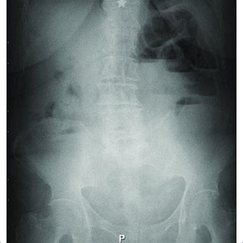 Abdominal X Ray Air Fluid Levels And Absence Of Distal Gas Are