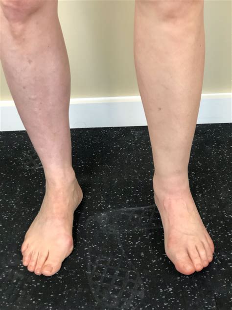 Prosthetic Silicone Skin For Amputees Prosthetic Leg Prosthetic Arm
