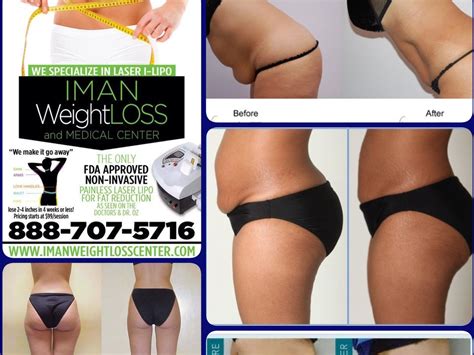 Laser Liposuction Love Handles Before And After