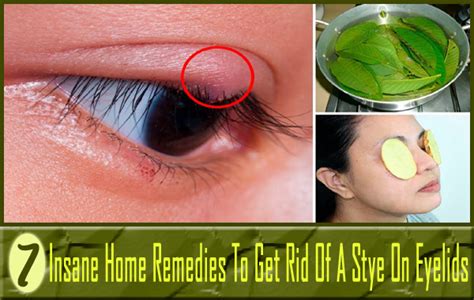 7 Insane Home Remedies To Get Rid Of A Stye On Eyelids