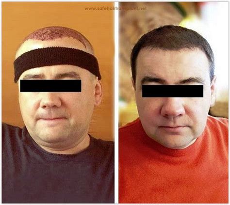 Prices start from as little as €1,100, and we offer our hair transplant services to people around the world. Greffe de cheveux Turquie Avant Après | Hair transplant ...