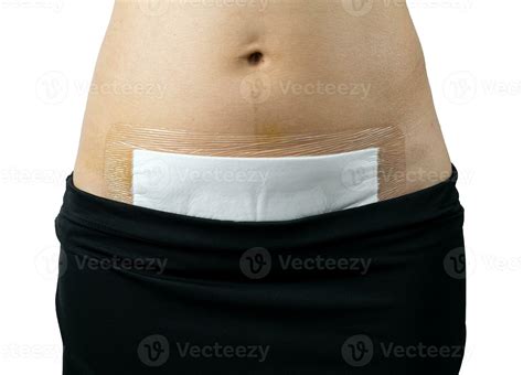 Surgical Incision On The Abdomen Of A Woman 24606221 Stock Photo At
