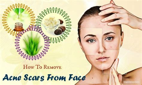 24 Tips How To Remove Acne Scars From Face Fast At Home