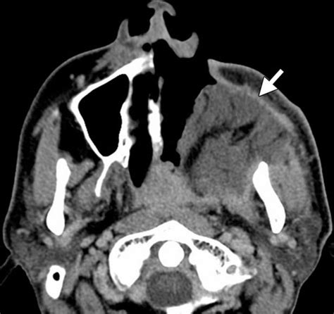 Posttreatment Ct And Mr Imaging In Head And Neck Cancer What The