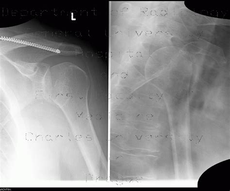 Radiology Case Posterior Dislocation Of Glenohumeral Joint