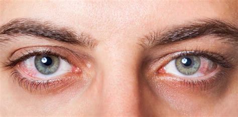 ¿qué es el síndrome de ojo seco optica luis trombettaoptica luis trombetta