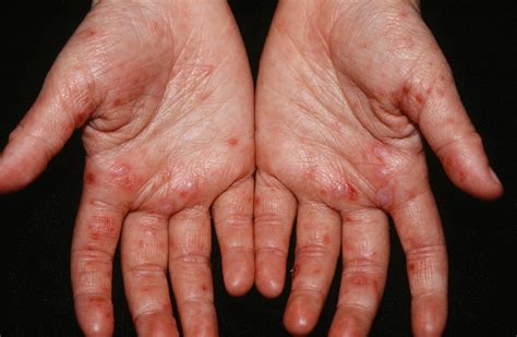 Pictures Of Hand Foot And Mouth Disease Htq