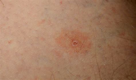 Tick Bite Pictures Symptoms Causes Treatment