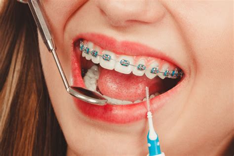 Orthodontic Braces What To Expect And How To Prepare
