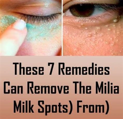 How To Remove Milia From Inner Eyelid Howotre