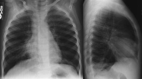 Normal Child Chest X Ray Images Galleries With A Bite