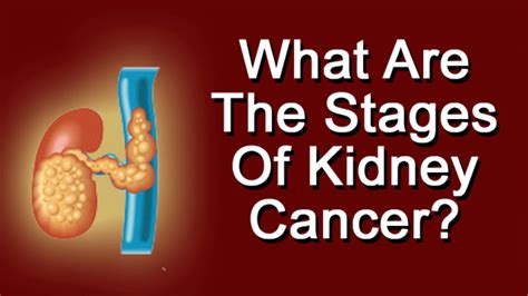 What Are The Stages Of Kidney Cancer Youtube