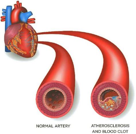What Is Arteriosclerosis And Atherosclerosis Onestepguide