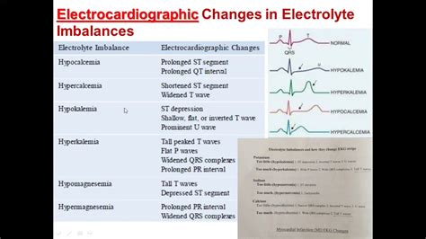 EKG Change In Electrolyte Imbalance ECG Changes Associated With Electrolyte Disturbances YouTube