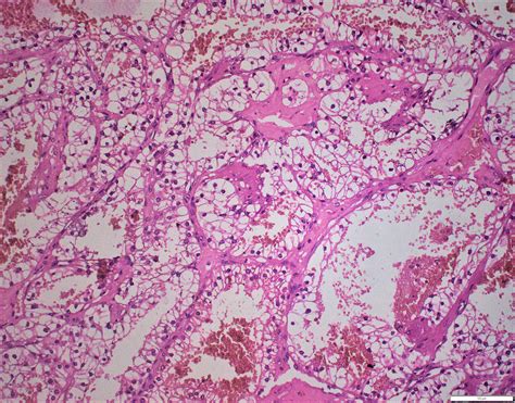 Latent Distant Metastasis Of Renal Cell Carcinoma To Skin A Case