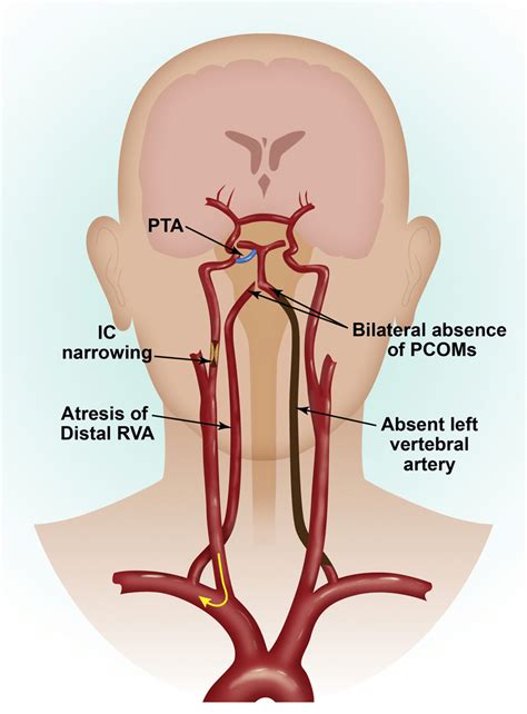 Occluded Left Internal Carotid Artery